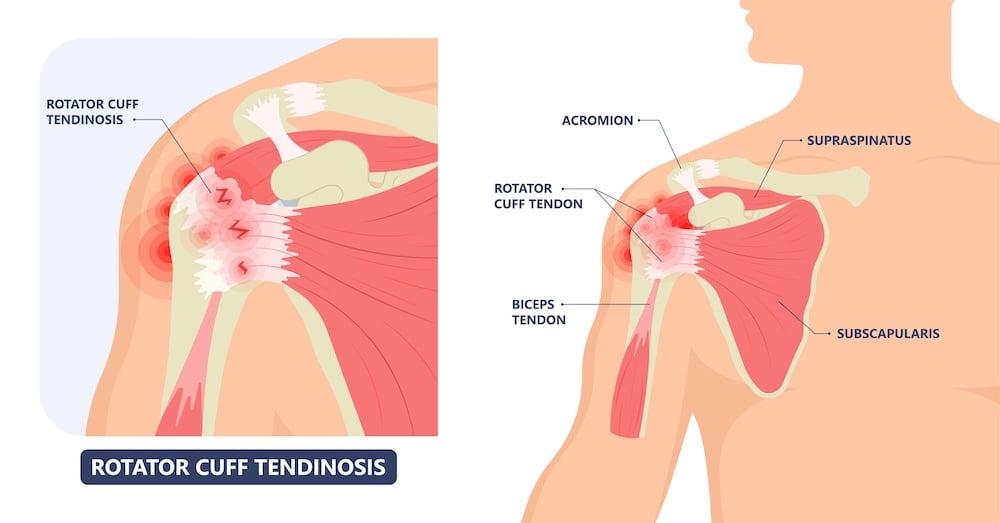 shoulder tendons
